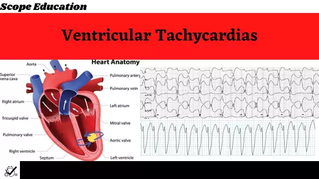 What are the symptoms and treatment of ventricular tachycardia?