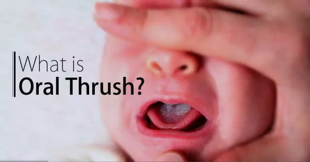 How is thrush treated in a child? Methods of folk and traditional medicine