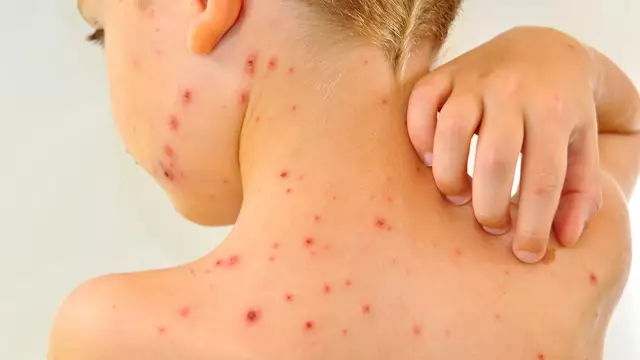 Chickenpox in a child: symptoms, forms, prevention