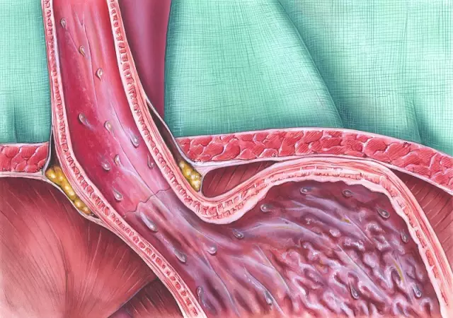 Mga sintomas at paggamot ng reflux esophagitis