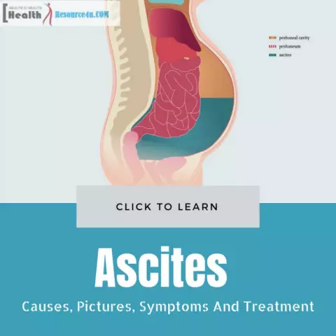 Treatment, causes and symptoms of ascites