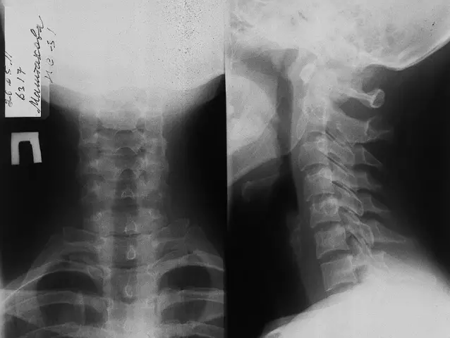 Osteocondrosis cervical y presión arterial. ¿Puede la osteocondrosis cervical aumentar la presión arterial?