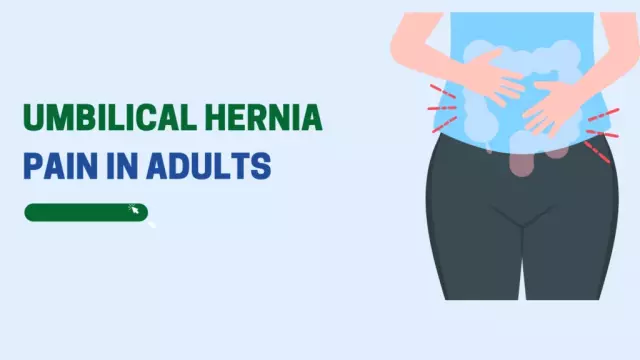 Umbilical hernia in adults: reviews of the operation, symptoms and treatment