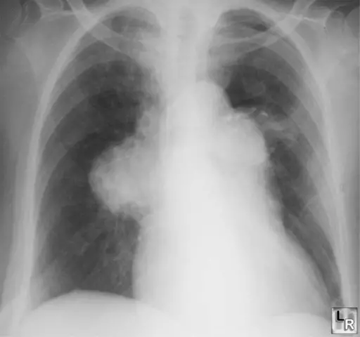 Arterial hypertension grade 2, risk 2: what does it mean?