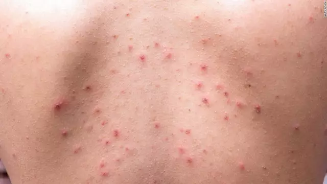 Chickenpox in the mouth: how and what to treat