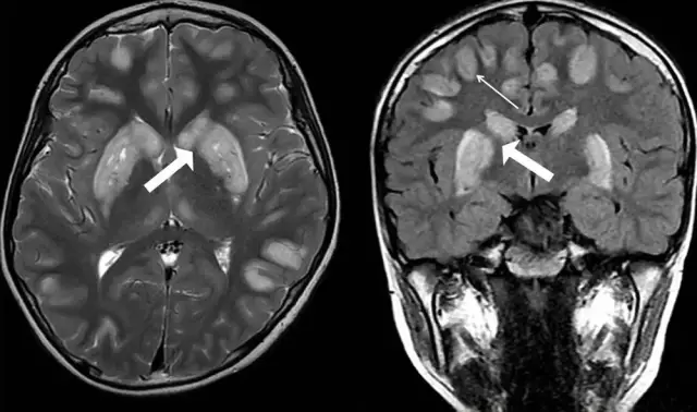 Microictus: consecuencias, síntomas y tratamiento