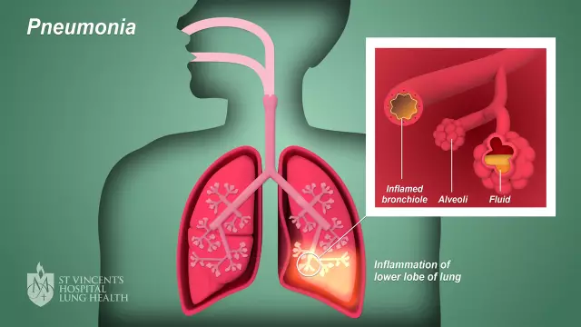 Is pneumonia serious?