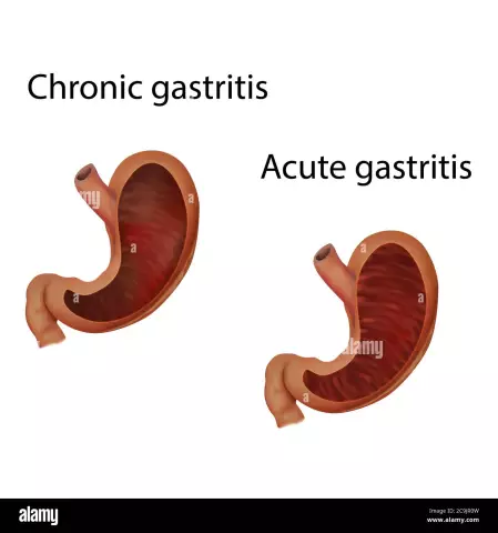 Chronic and acute gastritis in a child: signs and symptoms