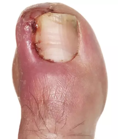 Ingrown toenail: causes and treatment