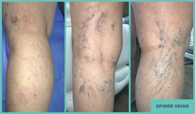 Spider veins on the legs: possible causes and treatments