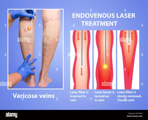 Varicose veins on the legs