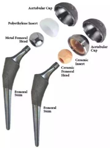 When is hip replacement necessary and what are the consequences of this operation?