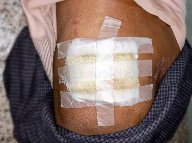 Buttock abscess after injection: photo, treatment