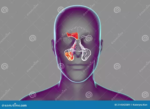 Kuvimba kwa sinuses za paranasal, au sinusitis ni nini