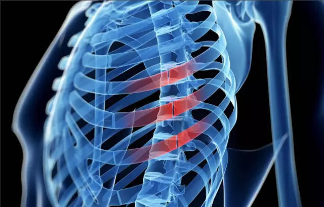 Rib fracture: symptoms and treatment