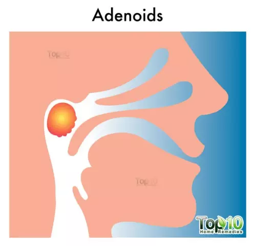 Adenoids in children: symptoms and treatment with folk remedies