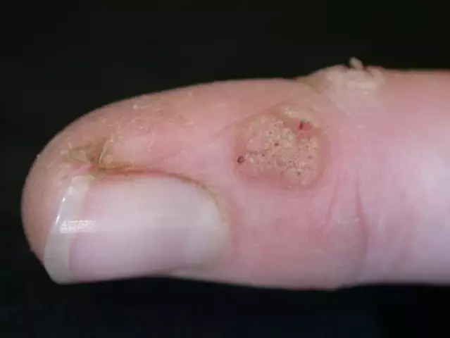 The reason for the appearance of warts on the hands. How to avoid them?