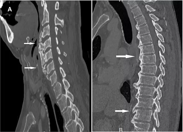 Osteófitos da coluna vertebral. Osteófitos da coluna cervical