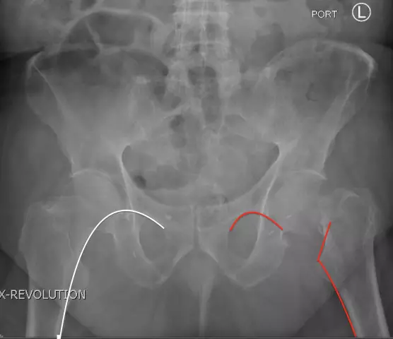 Fracture of the femoral neck in old age - is it a sentence?