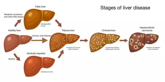 Primary symptoms of liver cirrhosis