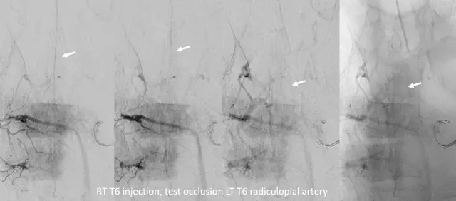 Hypoplasia ng kaliwang vertebral artery. Ang mga rason. Mga sintomas. Paggamot