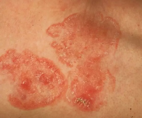 Red spots under the armpits: superficial mycosis and how to treat it