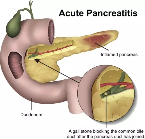 Symptom einer Erkrankung der Bauchspeicheldrüse oder welche Anzeichen bei einer Pankreatitis auftreten