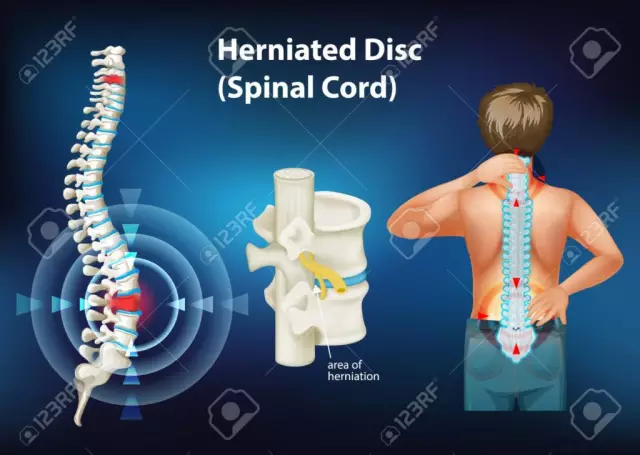 Protrusions: what is it? Protrusion of the intervertebral discs: treatment