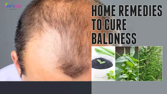 Why does a man go bald? Baldness remedy. How to treat baldness?