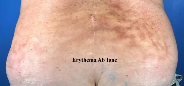 Erythema is a cause for concern?