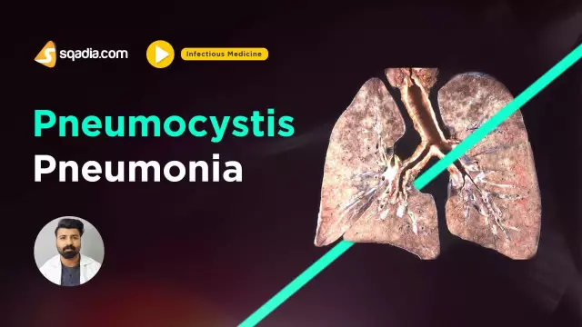 Viêm phổi do viêm phổi: nguyên nhân, triệu chứng, cách điều trị. Viêm phổi do Pneumocystis ở người nhiễm HIV