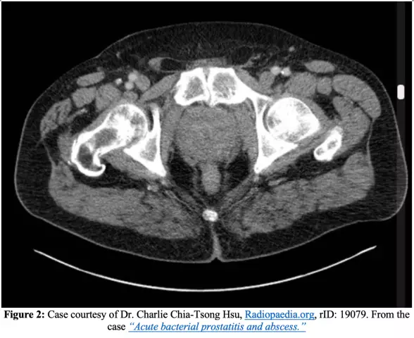 Why is prostatitis often accompanied by another disease - adenoma?