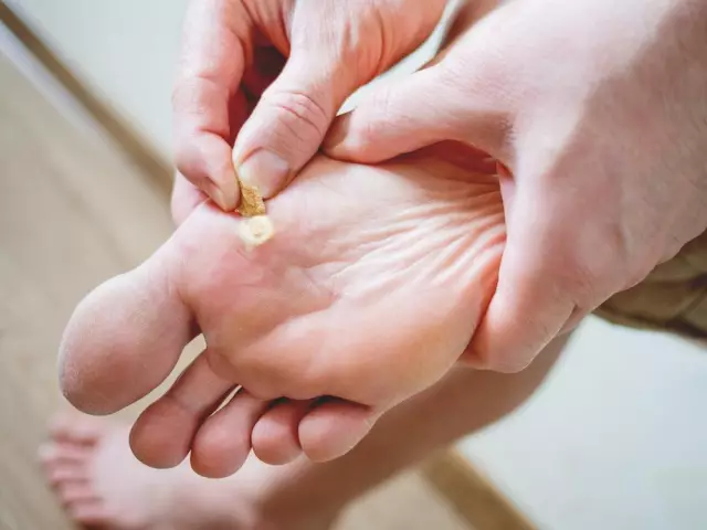 How to get rid of a wart at home? Several effective recipes