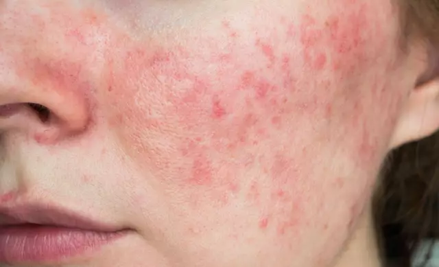 Is rosacea a disease or a cosmetic defect?