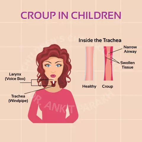 False croup: causes, symptoms, first aid, diagnosis and treatment