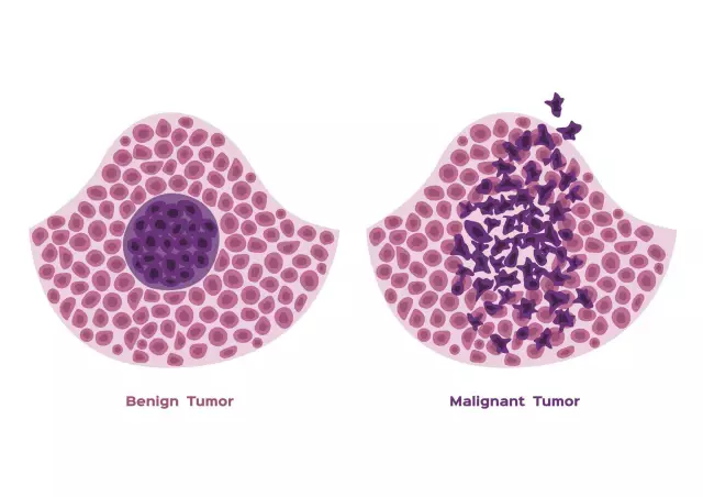 Classification and difference between a malignant tumor and a benign one