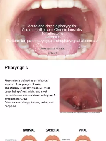 Etiology and symptoms of chronic pharyngitis