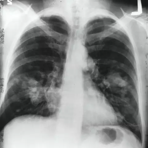 Symptoms of tuberculosis at an early stage. Early TB control