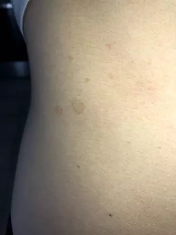 White spots on the skin (on a tan) why do they appear?