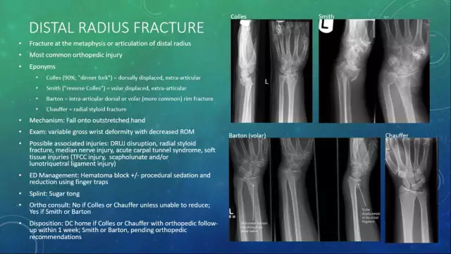 Radius. Description. Some types of fractures