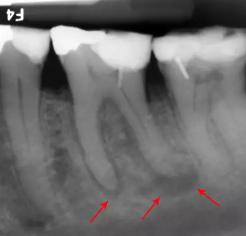 What is an abscess? Diagnosis and treatment