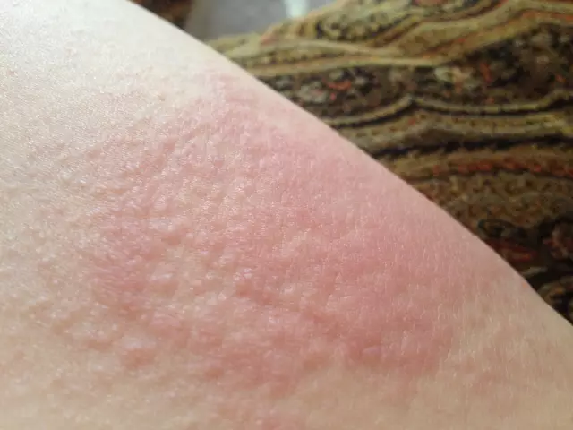 Itchy rash on legs: causes, prevention