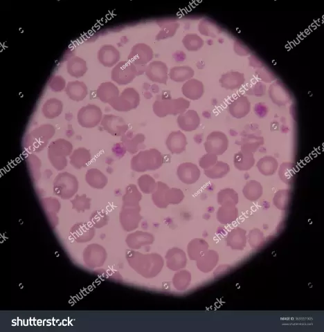 Increased platelets in a child: what could be the reasons?