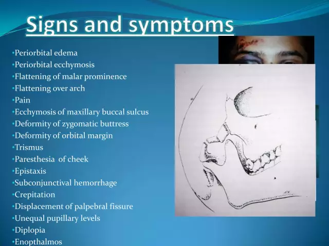 Fractures of the zygomatic bone with displacement