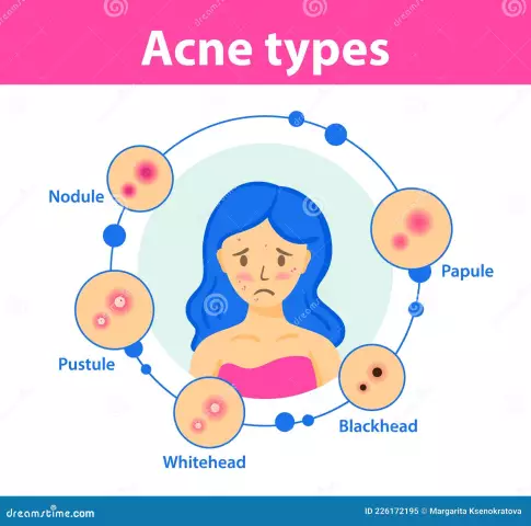 Acne disease: causes and treatment