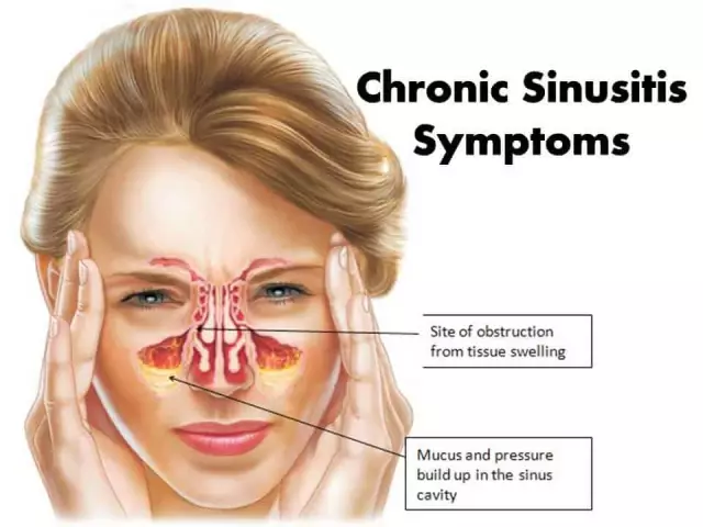 Sinusitis crónica: causas, síntomas y tratamientos