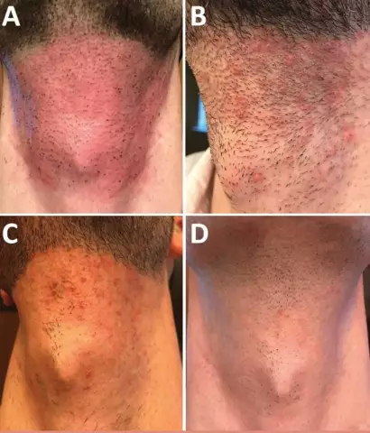 Ontsteking van die haarfollikels: oorsake, simptome, behandeling. Voorkoming van inflammasie van die haarfollikels