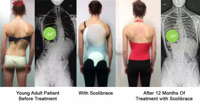 Scoliosis of the spine. Scoliosis: treatment. Scoliosis of the spine: symptoms