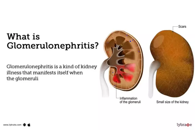 Chronic nephritis: causes, symptoms, treatment