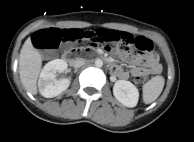 Antibiotic for pyelonephritis. Pyelonephritis: treatment (drugs)